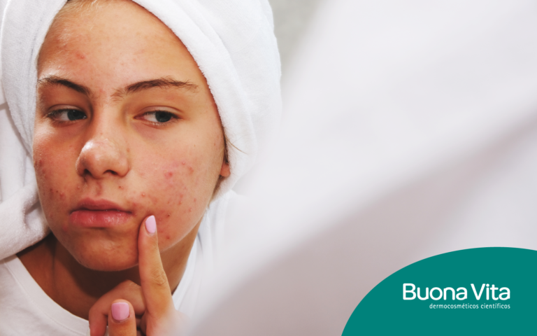 acne adulta